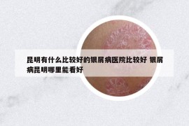 昆明有什么比较好的银屑病医院比较好 银屑病昆明哪里能看好