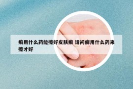 癣用什么药能擦好皮肤癣 请问癣用什么药来擦才好