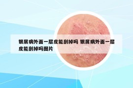 银屑病外面一层皮能刮掉吗 银屑病外面一层皮能刮掉吗图片