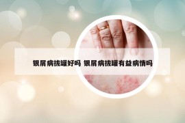 银屑病拔罐好吗 银屑病拔罐有益病情吗