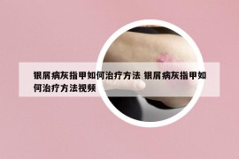 银屑病灰指甲如何治疗方法 银屑病灰指甲如何治疗方法视频