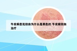 牛皮癣患处放血为什么是黑色的 牛皮廨放血治疗