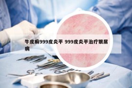 牛皮癣999皮炎平 999皮炎平治疗银屑病