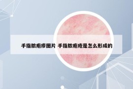 手指脓疱疹图片 手指脓疱疮是怎么形成的