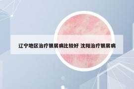 辽宁地区治疗银屑病比较好 沈阳治疗银屑病