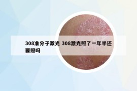 308准分子激光 308激光照了一年半还要照吗