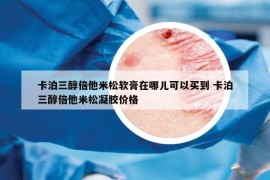 卡泊三醇倍他米松软膏在哪儿可以买到 卡泊三醇倍他米松凝胶价格