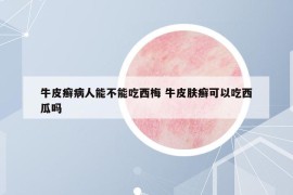 牛皮癣病人能不能吃西梅 牛皮肤癣可以吃西瓜吗