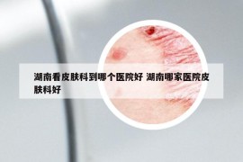 湖南看皮肤科到哪个医院好 湖南哪家医院皮肤科好