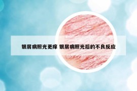 银屑病照光更痒 银屑病照光后的不良反应