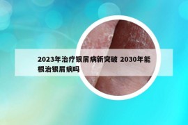 2023年治疗银屑病新突破 2030年能根治银屑病吗