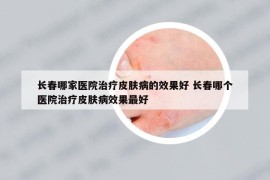 长春哪家医院治疗皮肤病的效果好 长春哪个医院治疗皮肤病效果最好