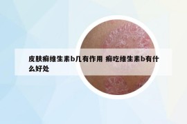 皮肤癣维生素b几有作用 癣吃维生素b有什么好处