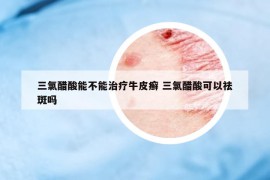 三氯醋酸能不能治疗牛皮癣 三氯醋酸可以祛斑吗