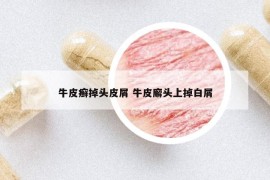 牛皮癣掉头皮屑 牛皮廨头上掉白屑