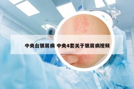 中央台银屑病 中央4套关于银屑病视频