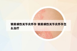 银屑病性关节炎怀孕 银屑病性关节炎怀孕怎么治疗