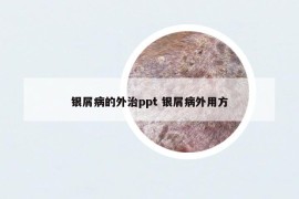 银屑病的外治ppt 银屑病外用方