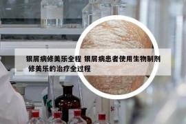 银屑病修美乐全程 银屑病患者使用生物制剂 修美乐的治疗全过程