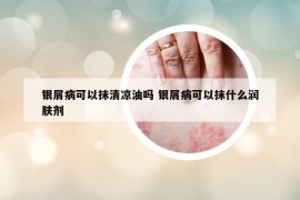 银屑病可以抹清凉油吗 银屑病可以抹什么润肤剂