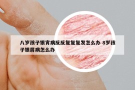 八岁孩子银宵病反反复复复发怎么办 8岁孩子银屑病怎么办