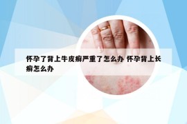 怀孕了背上牛皮癣严重了怎么办 怀孕背上长癣怎么办