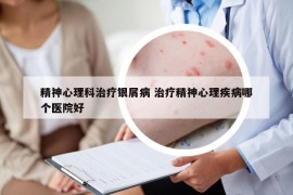 精神心理科治疗银屑病 治疗精神心理疾病哪个医院好