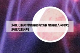 多维元素片对银屑病有效果 银屑病人可以吃多维元素片吗