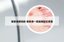 银屑病使劲抓 银屑病一抓就痒起红疙瘩