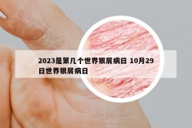 2023是第几个世界银屑病日 10月29日世界银屑病日