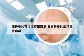 吃丹参片可以治疗银屑病 复方丹参片治疗银屑病吗