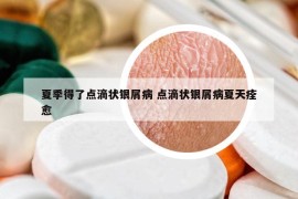 夏季得了点滴状银屑病 点滴状银屑病夏天痊愈