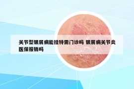 关节型银屑病能挂特需门诊吗 银屑病关节炎医保报销吗