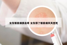 女生银屑病很自卑 女生得了银屑病天天想死