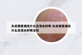 头皮银屑病洗什么洗发水好呢 头皮银屑病洗什么洗发水好呢女性