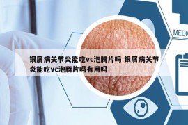 银屑病关节炎能吃vc泡腾片吗 银屑病关节炎能吃vc泡腾片吗有用吗