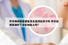 怀孕期间银屑病复发会遗传给孩子吗 怀孕后银屑病好了会影响胎儿吗?