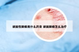 顽固性脚癣用什么药膏 顽固脚癣怎么治疗