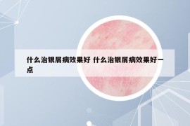 什么治银屑病效果好 什么治银屑病效果好一点