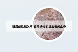 银屑病性膝关节 银屑病性的膝盖痛怎么查