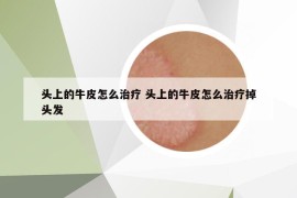 头上的牛皮怎么治疗 头上的牛皮怎么治疗掉头发