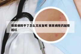 银屑病擦平了怎么又反复呢 银屑病擦药越擦越红