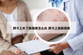 脖子上长了藓很痒怎么办 脖子上张藓很痒