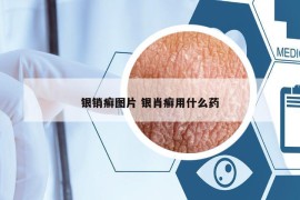 银销癣图片 银肖癣用什么药