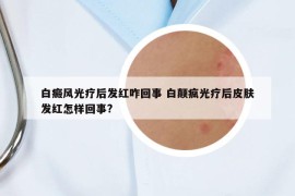 白癜风光疗后发红咋回事 白颠疯光疗后皮肤发红怎样回事?