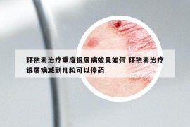 环孢素治疗重度银屑病效果如何 环孢素治疗银屑病减到几粒可以停药