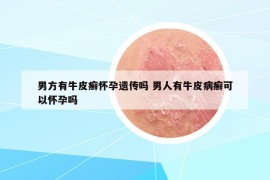 男方有牛皮癣怀孕遗传吗 男人有牛皮病癣可以怀孕吗