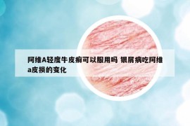 阿维A轻度牛皮癣可以服用吗 银屑病吃阿维a皮损的变化