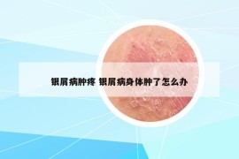 银屑病肿疼 银屑病身体肿了怎么办