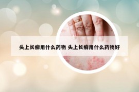 头上长癣用什么药物 头上长癣用什么药物好